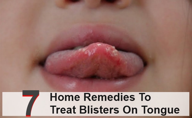 7-amazing-home-remedies-to-treat-blisters-on-tongue-morpheme-remedies