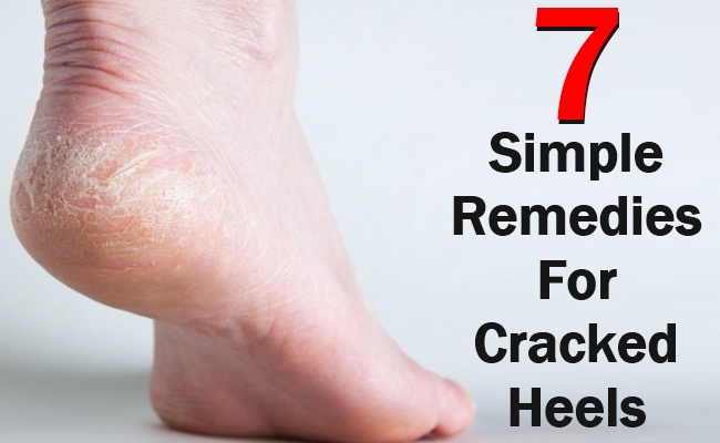 How to Treat Cracked Heels - for good! - Live Laugh Rowe